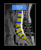 Colorized Lumbar MRI